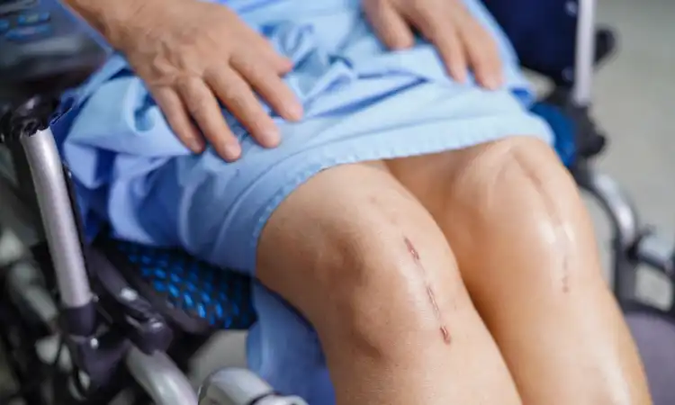 A catastrophic injury survivor being wheeled in a chair with scars from surgery in her knees.