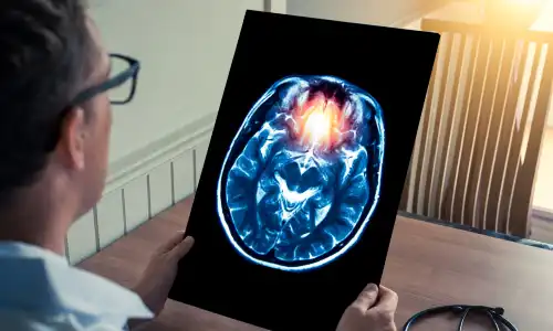 A doctor looking at a brain scan of a patient with a damaged area tinted orange.