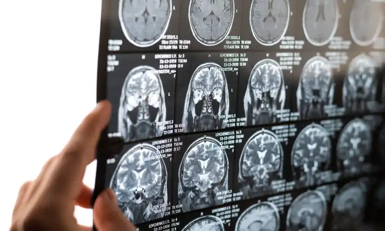 A doctor's hand holding up a brain scan against a viewing light to look at an injury.